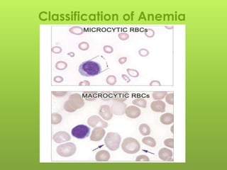 Classification of Anemia
 