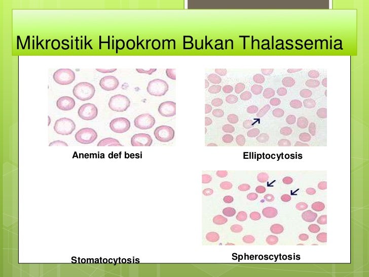 histogram h-s Anemia pds patklin histogram h-s Anemia pds patklin