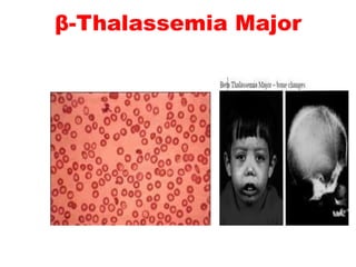 β-Thalassemia Major
 