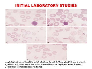 INITIAL LABORATORY STUDIES
Morphologic abnormalities of the red blood cell. A, Normal. B, Macrocytes (folic acid or vitamin
B12deficiency). C, Hypochromic microcytes (iron deficiency). D, Target cells (Hb CC disease).
E, Schizocytes (hemolytic-uremic syndrome).
 