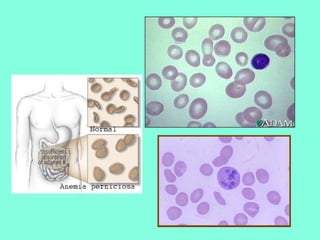 Anemia perniciosa