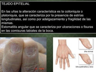 TEJIDO EPITELIAL
En las uñas la alteración característica es la coiloniquia o
platoniquia, que se caracteriza por la presencia de estrías
longitudinales, así como por adelgazamiento y fragilidad de las
mismas.
Estomatitis angular que se caracteriza por ulceraciones o fisuras
en las comisuras labiales de la boca.
 