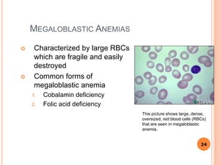 MEGALOBLASTIC ANEMIAS
 Characterized by large RBCs
which are fragile and easily
destroyed
 Common forms of
megaloblastic anemia
1. Cobalamin deficiency
2. Folic acid deficiency
24
This picture shows large, dense,
oversized, red blood cells (RBCs)
that are seen in megaloblastic
anemia.
 