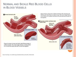 NORMAL AND SICKLE RED BLOOD CELLS
IN BLOOD VESSELS
43
Figure A shows normal red blood cells flowing freely in
a blood vessel. The inset image shows a cross-section
of a normal red blood cell with normal hemoglobin.
Figure B shows abnormal, sickled red blood cells clumping and
blocking the blood flow in a blood vessel. The inset image shows a
cross-section of a sickled red blood cell with abnormal strands of
hemoglobin.
Source from http://www.nhlbi.nih.gov/health/dci/Diseases/Sca/SCA_WhatIs.html
 
