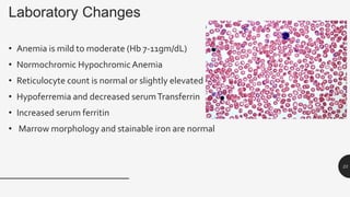 Laboratory Changes
• Anemia is mild to moderate (Hb 7-11gm/dL)
• Normochromic HypochromicAnemia
• Reticulocyte count is normal or slightly elevated
• Hypoferremia and decreased serumTransferrin
• Increased serum ferritin
• Marrow morphology and stainable iron are normal
23
 