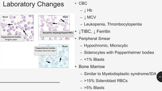 Laboratory Changes • CBC
– ↓ Hb
– ↓ MCV
– Leukopenia, Thrombocytopentia
• ↓TIBC, ↓ Ferritin
• Peripheral Smear
– Hypochromic, Microcytic
– Siderocytes with Pappenheimer bodies
– <1% Blasts
• Bone Marrow
– Similar to Myelodisplastic syndrome/IDA
– >15% Sideroblast RBCs
– >5% Blasts
28
 