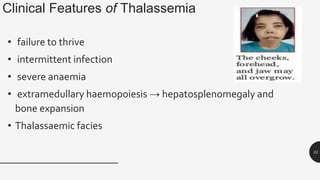 Clinical Features of Thalassemia
• failure to thrive
• intermittent infection
• severe anaemia
• extramedullary haemopoiesis → hepatosplenomegaly and
bone expansion
• Thalassaemic facies
32
 