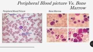 Peripheral Blood picture Vs. Bone
Marrow
Peripheral Blood Picture Bone Marrow
46
 