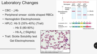 Laboratory Changes
• CBC - ↓Hb
• Peripheral smear- sickle shaped RBCs
• Hemoglobin Electrophoresis
• HPLC: Hb S (35%-40%) (Trait)
– Hb S (80-90%)
– Hb A2 (↑Slightly)
• Trait: Sickle Solubility test
Gel Electrophoresis
62
 