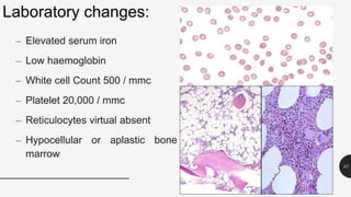 Laboratory changes:
– Elevated serum iron
– Low haemoglobin
– White cell Count 500 / mmc
– Platelet 20,000 / mmc
– Reticulocytes virtual absent
– Hypocellular or aplastic bone
marrow
67
 