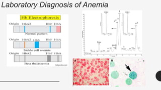 73
Laboratory Diagnosis of Anemia
 