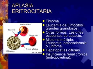 APLASIA ERITROCITARIA Timoma. Leucemia de Linfocitos grandes granulosos. Otras formas: Lesiones ocupantes de espacio. Mieloma múltiple, Leucemia, osteosclerosis o Linfoma. Hepatopatías difusas. Insuficiencia renal crónica (eritropoyetina). 