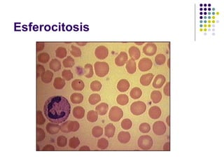 Esferocitosis
 
