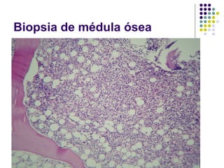 Biopsia de médula ósea
 