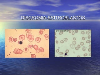 DISCROMIA-ERITROBLASTOSDISCROMIA-ERITROBLASTOS
 
