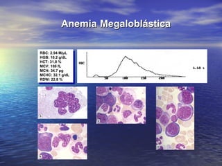 AnemiaAnemia MegaloblásticaMegaloblástica
RBC: 2.94 M/µL
HGB: 10.2 g/dL
HCT: 31.8 %
MCV: 108 fL
MCH: 34.7 pg
MCHC: 32.1 g/dL
RDW: 22.8 %
RBC: 2.94 M/µL
HGB: 10.2 g/dL
HCT: 31.8 %
MCV: 108 fL
MCH: 34.7 pg
MCHC: 32.1 g/dL
RDW: 22.8 %
 