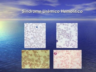 Sindrome Urémico HemolíticoSindrome Urémico Hemolítico
 