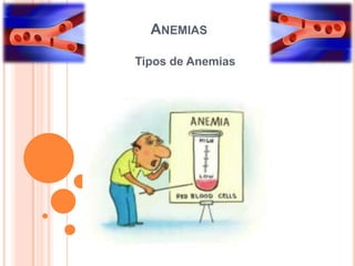 ANEMIAS
Tipos de Anemias
 