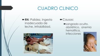CUADRO CLINICO
RN: Palidez, ingesta
inadecuada de
leche, irritabilidad.
Causas:
sangrado oculto,
obstétrico, anemia
hemolítica,
infecciones
 
