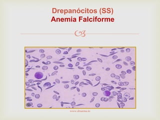 
Drepanócitos (SS)
Anemia Falciforme
www.drsarma.in
 