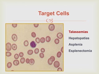 
Target Cells
Talassemias
Hepatopatias
Asplenia
Esplenectomia
 