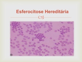 
Esferocitose Hereditária
 