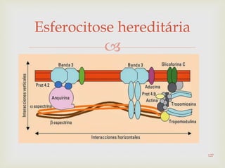 
Esferocitose hereditária
127
 