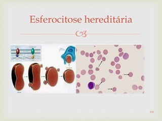 
Esferocitose hereditária
131
 