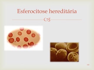 
Esferocitose hereditária
132
 