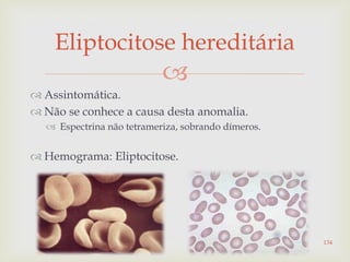 
 Assintomática.
 Não se conhece a causa desta anomalia.
 Espectrina não tetrameriza, sobrando dímeros.
 Hemograma: Eliptocitose.
Eliptocitose hereditária
134
 
