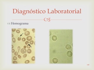  Hemograma
Diagnóstico Laboratorial
140
 