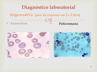 
Diagnóstico laboratorial
 Anisocitose
*
 Policromasia
Regenerativa (pico da resposta em 2 a 3 dias)
148
 