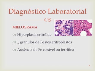
Diagnóstico Laboratorial
MIELOGRAMA
 Hiperplasia eritróide
 ↓ grânulos de Fe nos eritroblastos
 Ausência de Fe corável ou ferritina
28
 