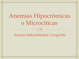 
Anemias Hipocrômicas
e Microcíticas
Anemia Sideroblástica Congênita
37
 