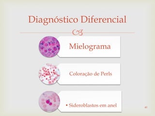 
Diagnóstico Diferencial
Mielograma
Coloração de Perls
• Sideroblastos em anel 40
 