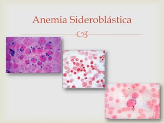 
Anemia Sideroblástica
41
 