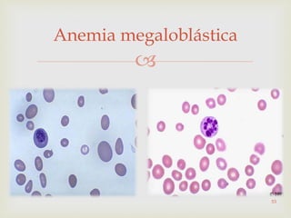 
Anemia megaloblástica
53
 