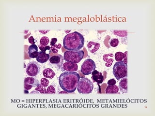 
Anemia megaloblástica
MO = HIPERPLASIA ERITRÓIDE, METAMIELÓCITOS
GIGANTES, MEGACARIÓCITOS GRANDES 54
 