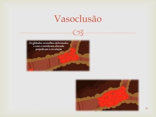 
Vasoclusão
81
 