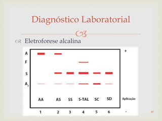  Eletroforese alcalina
Diagnóstico Laboratorial
87
 