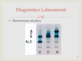  Eletroforese alcalina
Diagnóstico Laboratorial
88
 