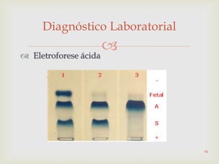  Eletroforese ácida
Diagnóstico Laboratorial
90
 