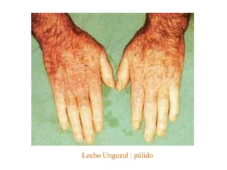 Lecho Ungueal : pálido
 