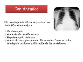 El corazón puede dilatarse y entrar en
falla (Cor Anémico) por:
 Cardiomegalia
 Aumento de presión venosa
 Hepatomegalia dolorosa
 Aparición de soplos pan sistólicos en los focos mitral y
tricúspide debido a la dilatación de los ventrículos
Cor Anémico
 