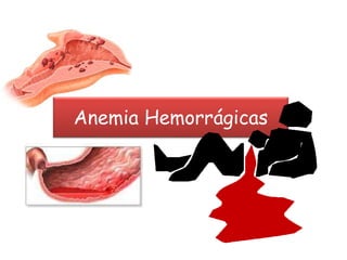 Anemia Hemorrágicas
 