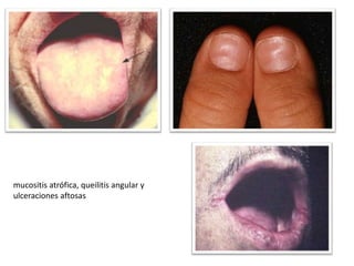 mucositis atrófica, queilitis angular y
ulceraciones aftosas
 