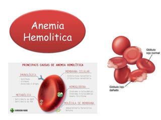 Anemia
Hemolitica
 