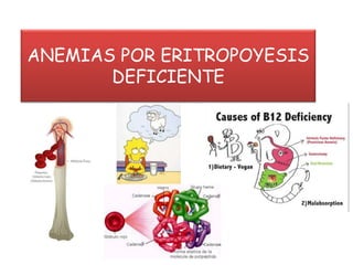ANEMIAS POR ERITROPOYESIS
DEFICIENTE
 