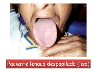 Paciente lengua despapilada (lisa)
 