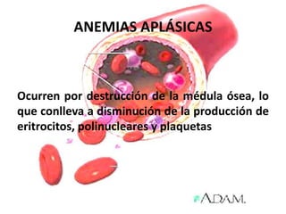 ANEMIAS APLÁSICAS
Ocurren por destrucción de la médula ósea, lo
que conlleva a disminución de la producción de
eritrocitos, polinucleares y plaquetas
 